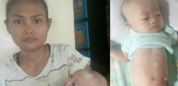 Muhammad Amriansyah Suparjo, Bayi Lahir Tanpa ANUS Muhammad Amriansyah Suparjo, Bayi Lahir Tanpa ANUS